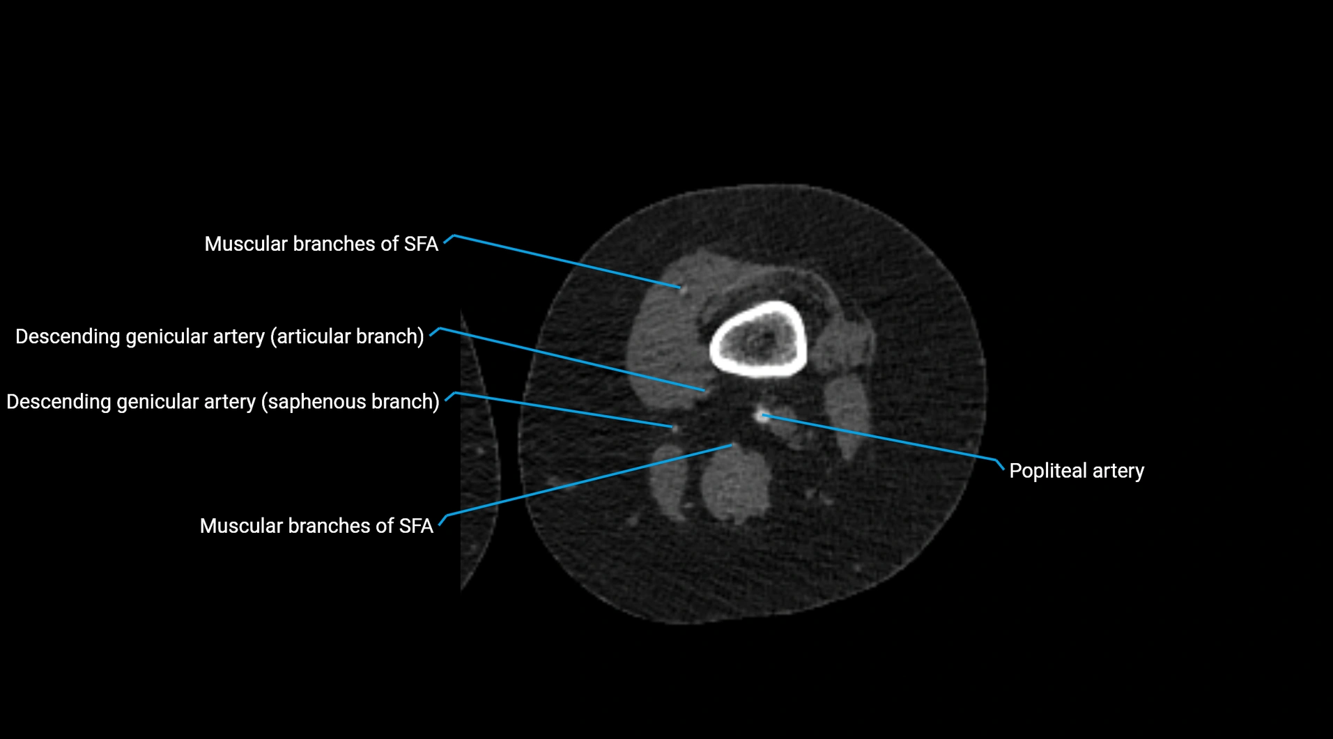 CTA lower limb cross sectional anatomy labelled image _159.webp